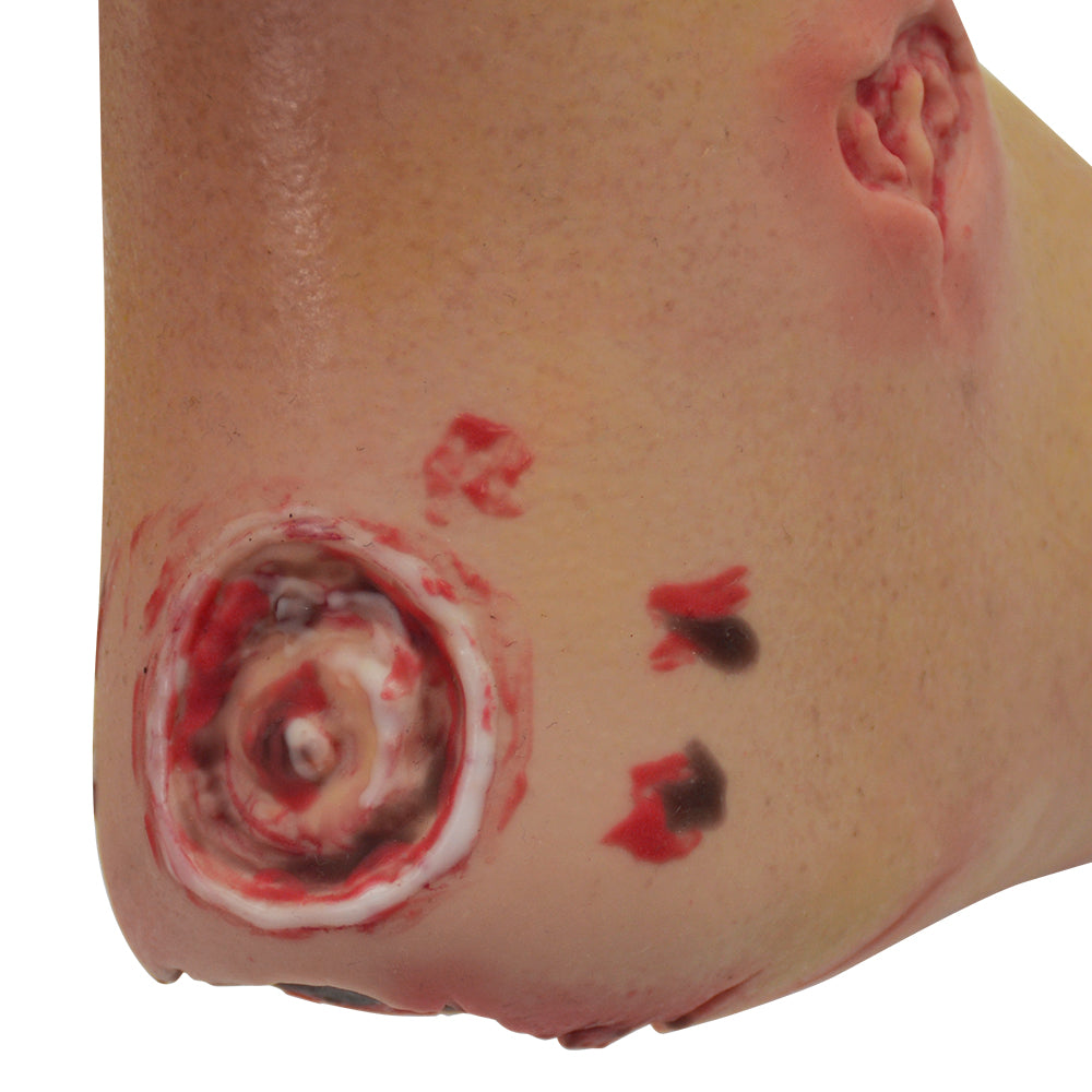 Severe Diabetic Foot Model With Wounds