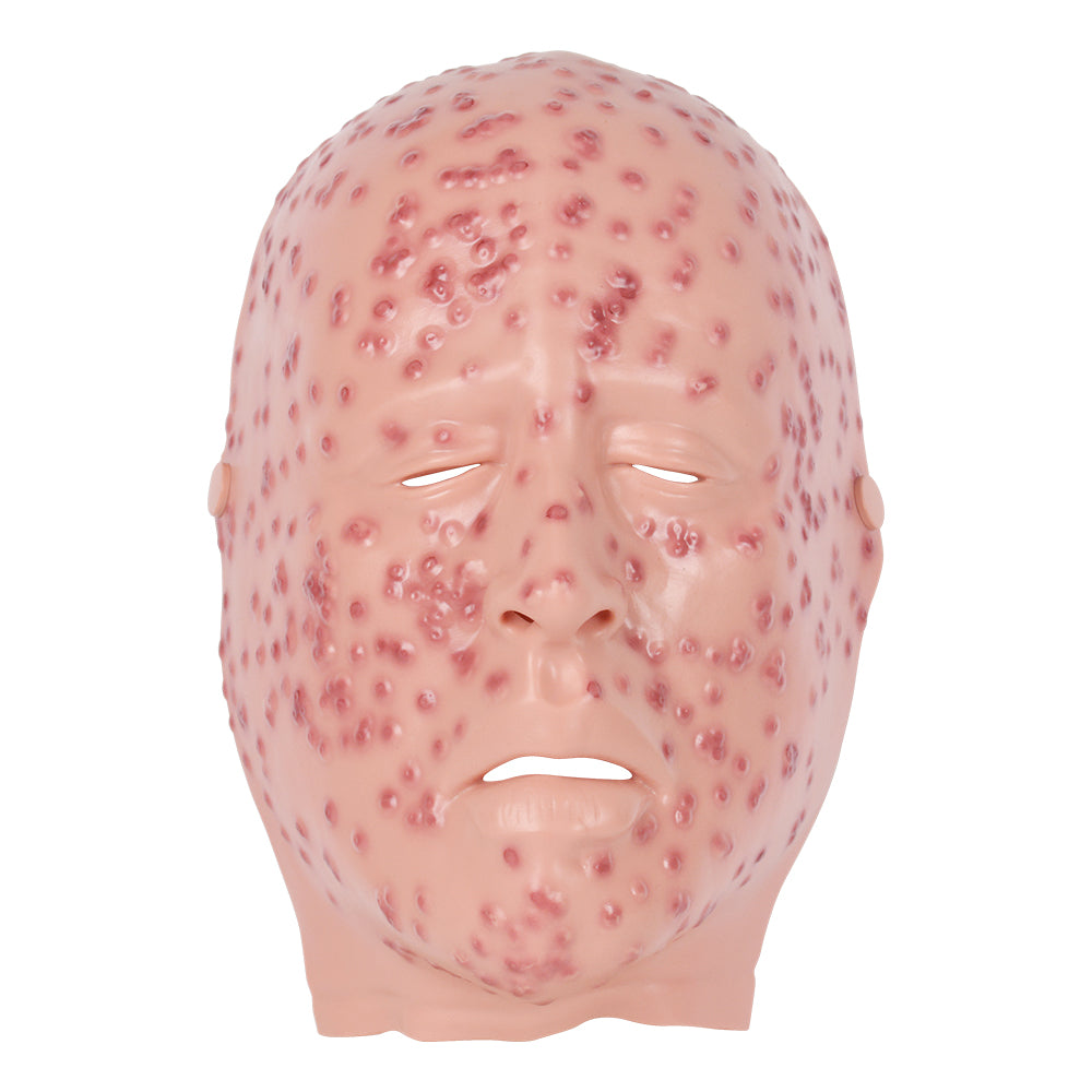 Severe Smallpox Face Moulage For Training