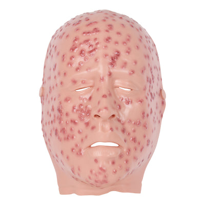 Severe Smallpox Face Moulage For Training