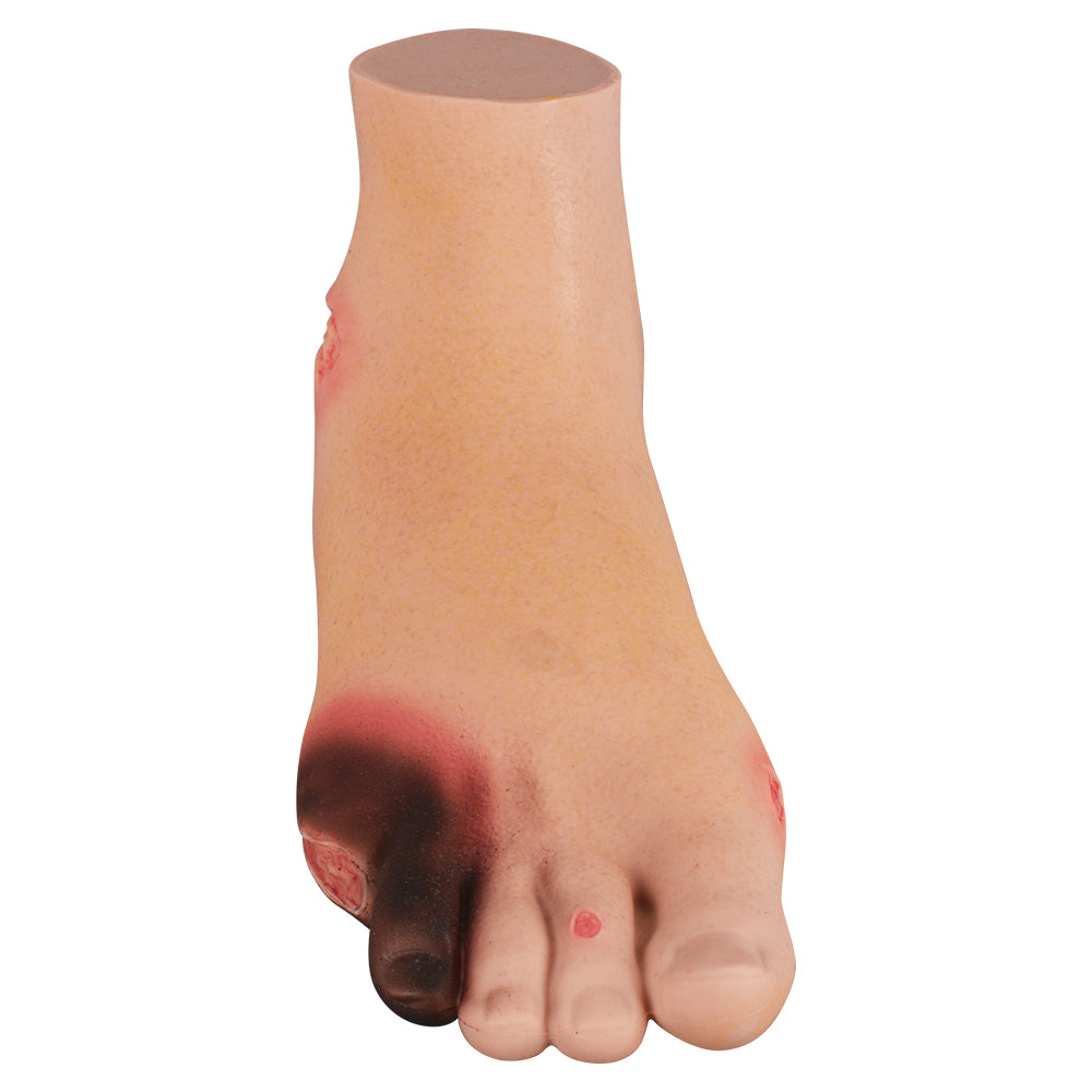 Silicone Severe Diabetic Foot Training Model