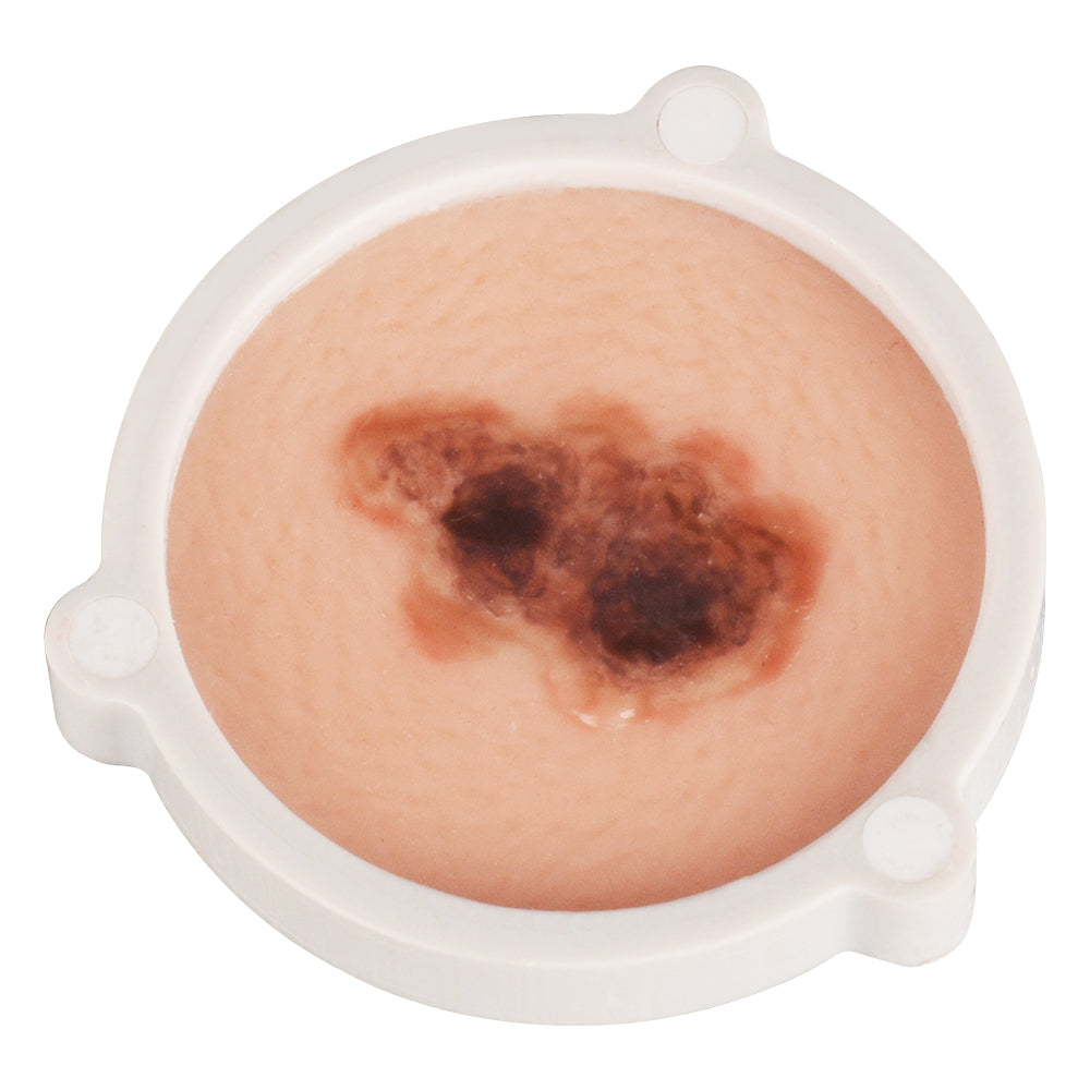 Skin Cancer Model for Medical and Dermatology Training