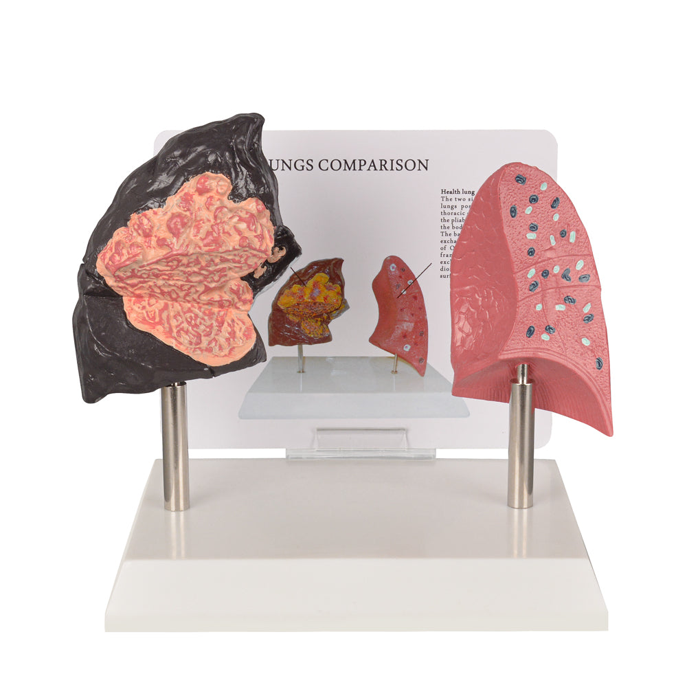 Smoker’s Lung Model