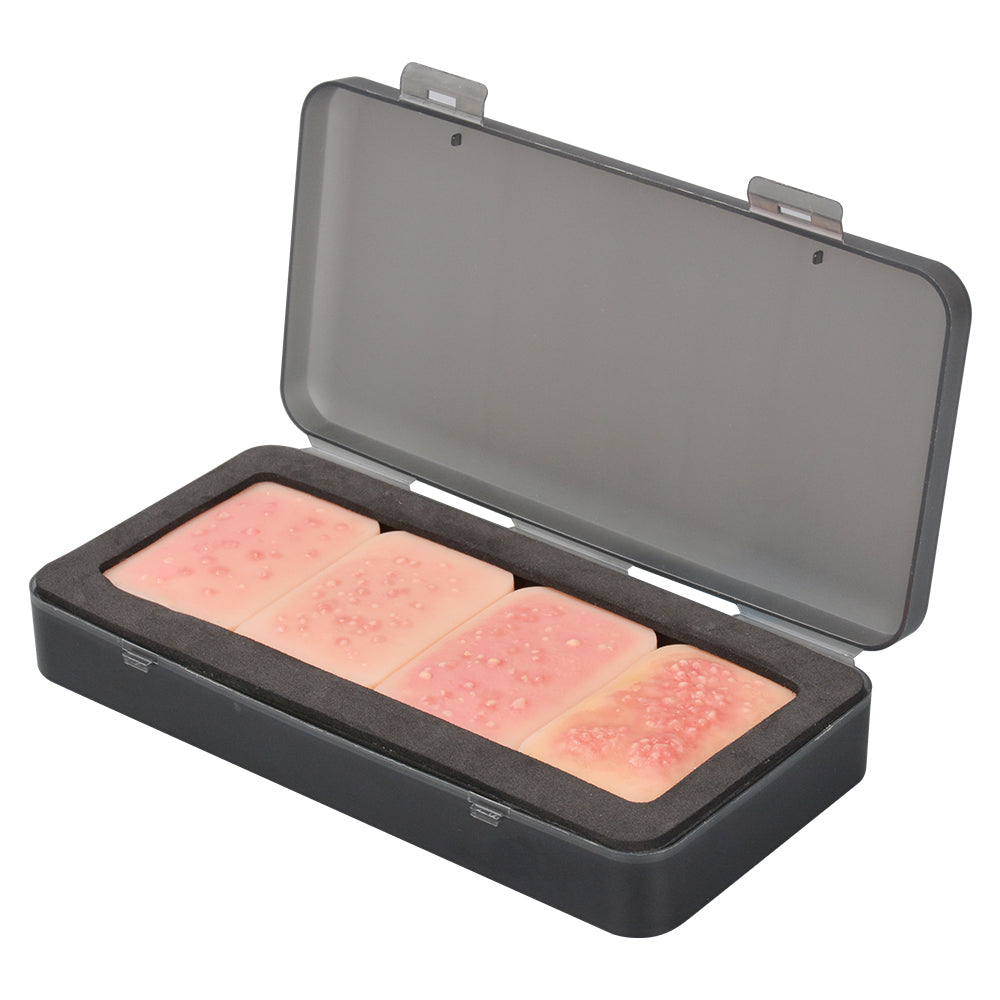 Stage 1-4 Facial Acne Progression Model for Dermatology Training and Patient Education 