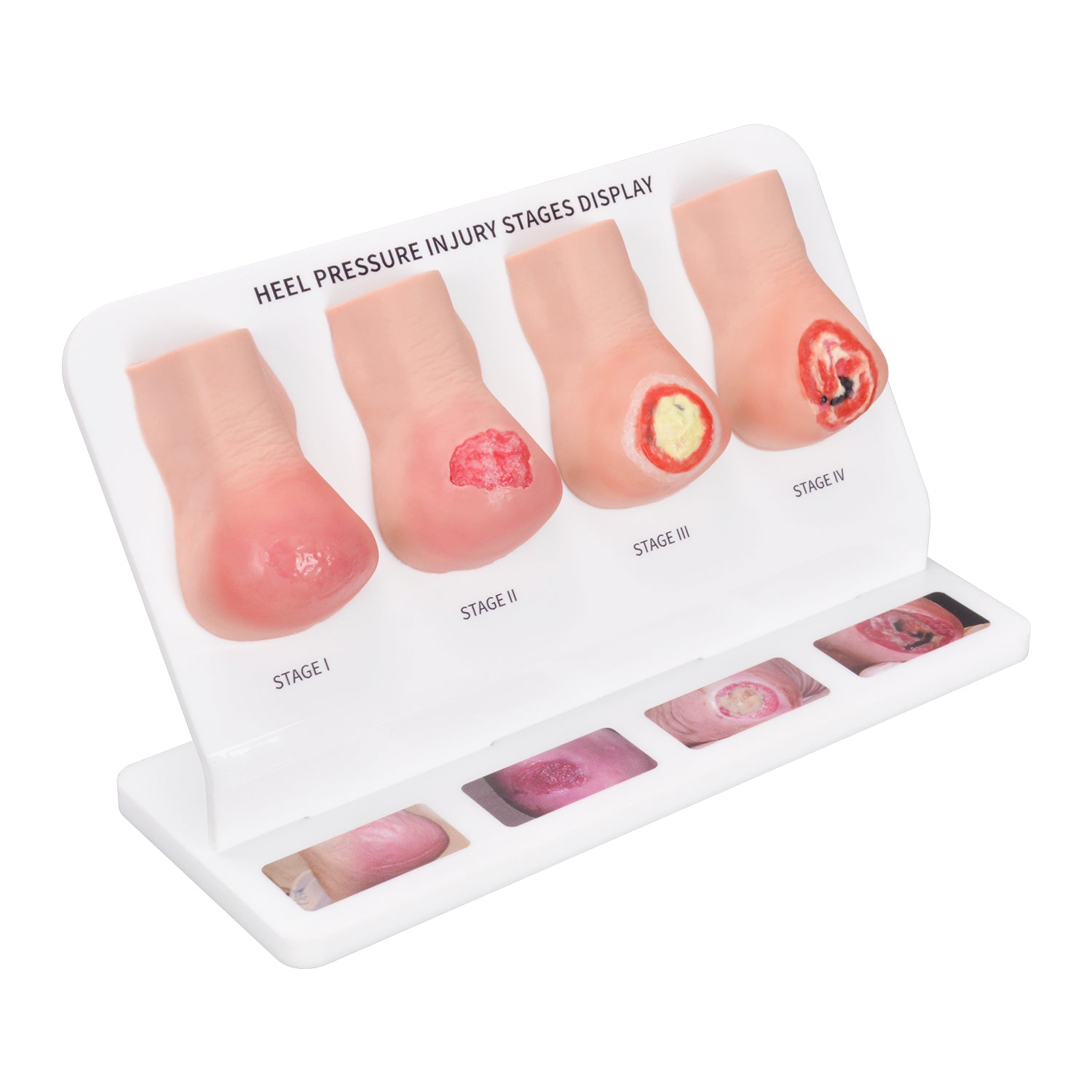 Stage 1–4 Heel Pressure Ulcer Training Model