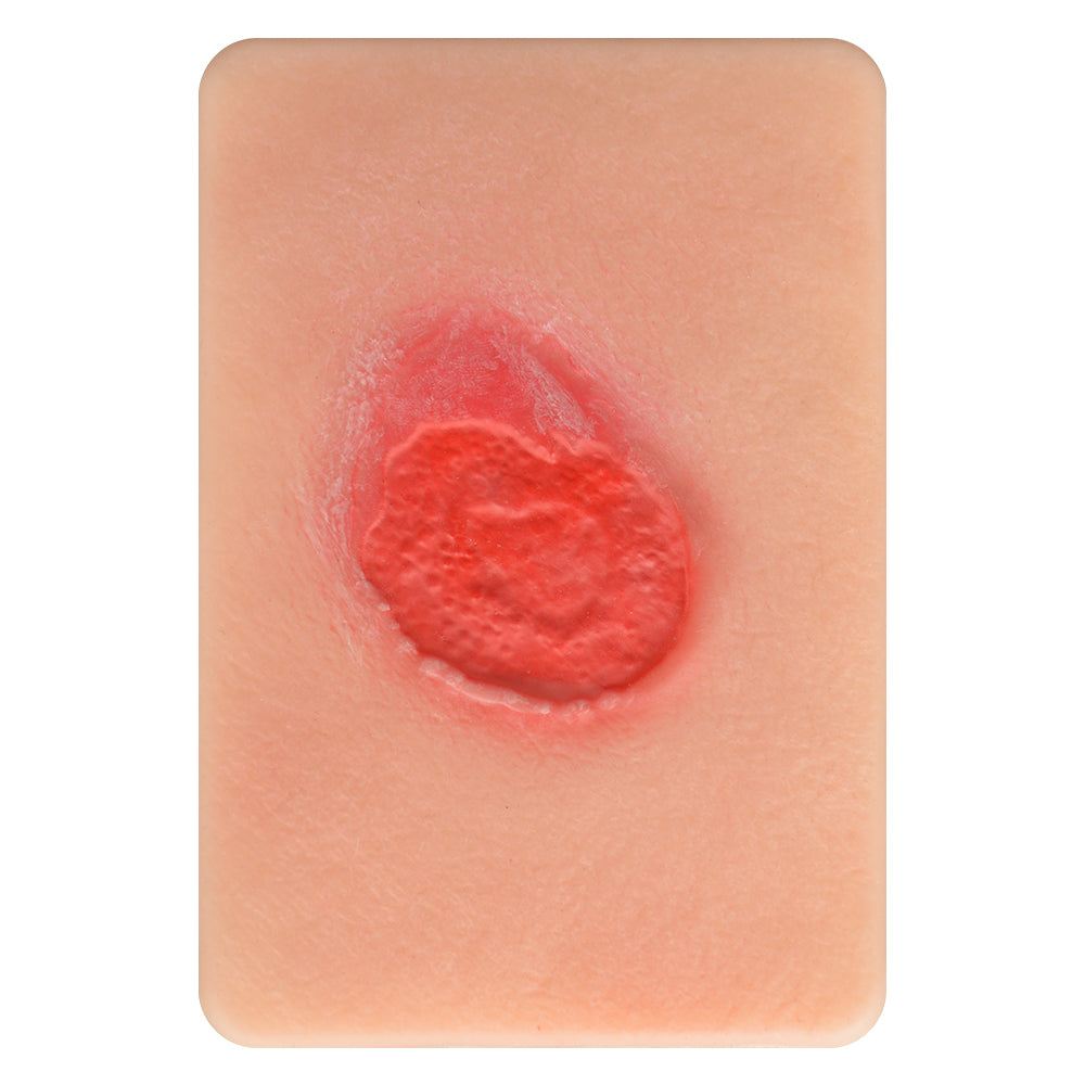 Stage 2 Pressure Ulcer Training Model