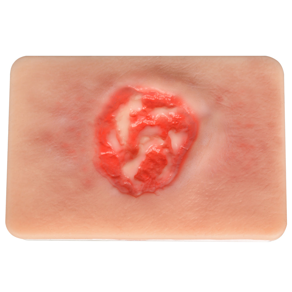 Stage 3 Pressure Ulcer Training Model