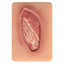 Stage 4 Pressure Ulcer Training Model