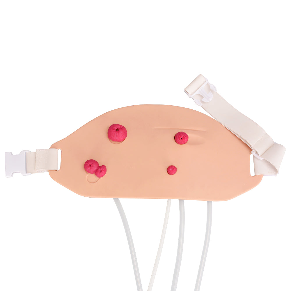 Stoma Model for Hands-On Ostomy Training