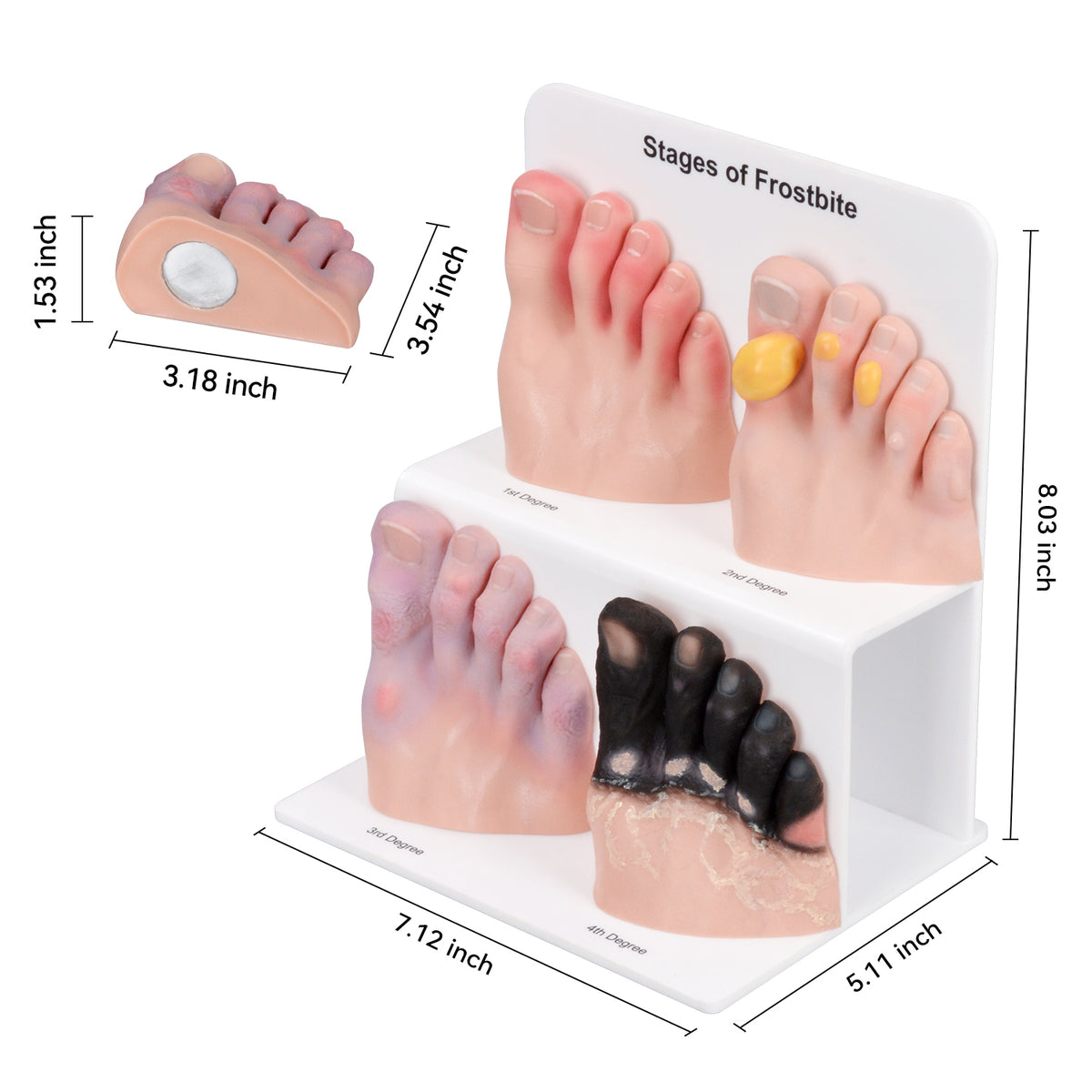 Frostbite Model Tools Foot Toe Frostbite Model for Medical Training, Teaching, Patient ...