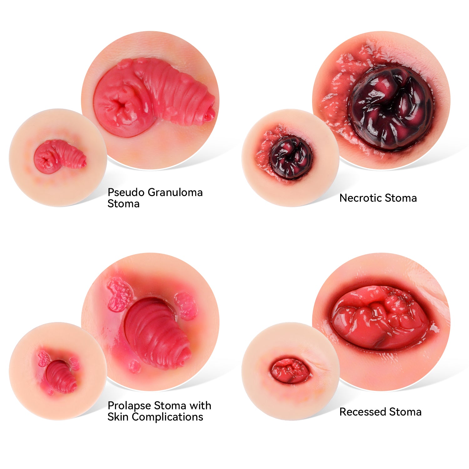 Unhealthy & Abnormal Stoma Model for Ostomy Care Training