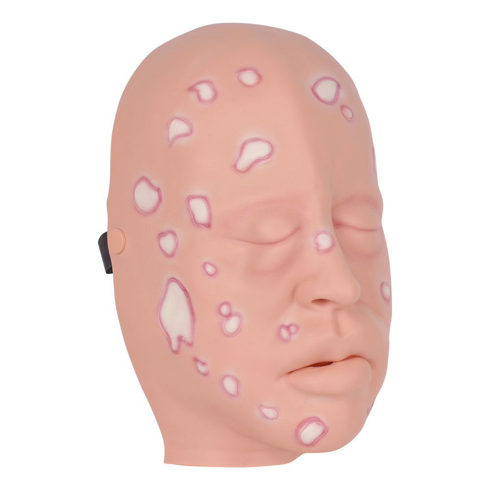 Face Moulage Wound-Mustard Gas Face – Medarchitect