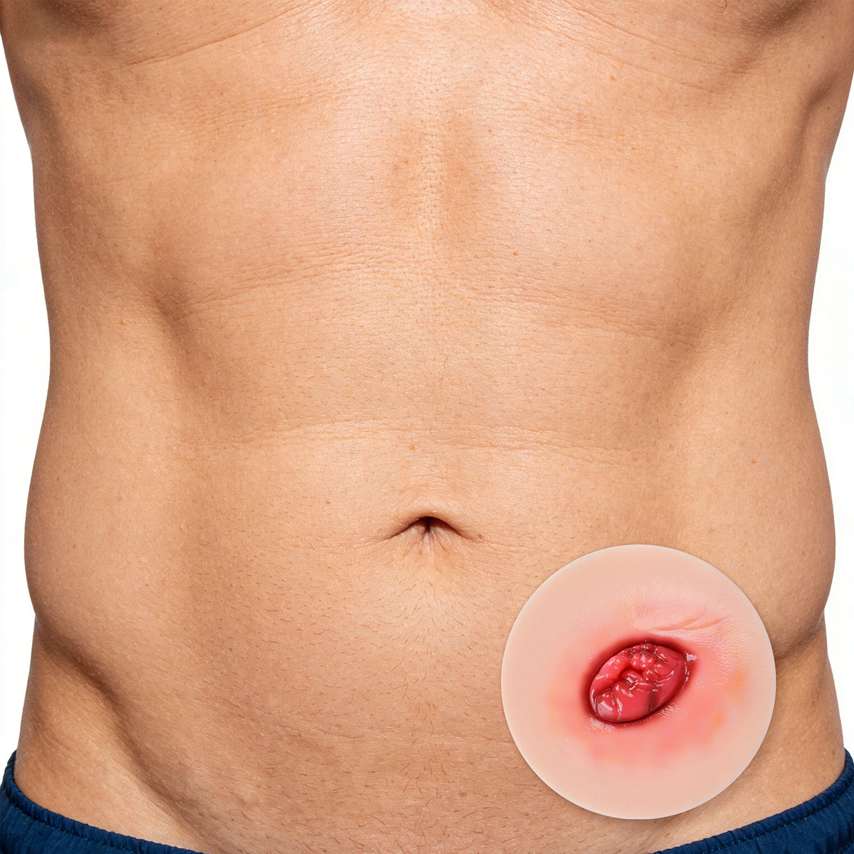 Sticky Similation Sticky Unhealthy Stoma Simulation Model (Set of 4) – Medarchitect