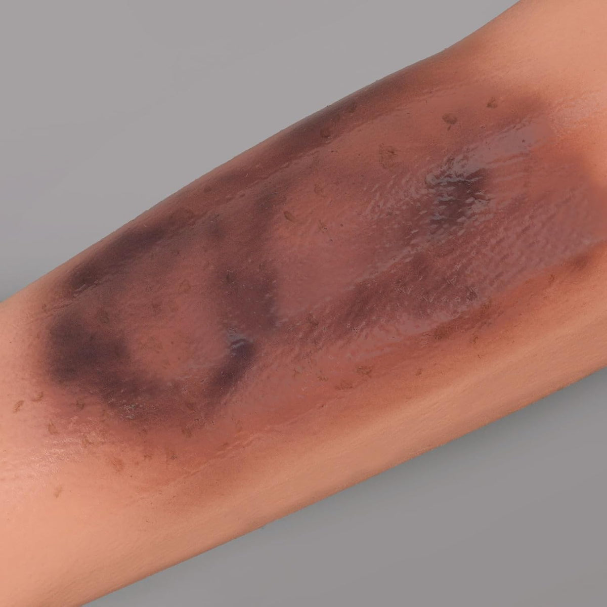 Wearable Bruise Wound Model